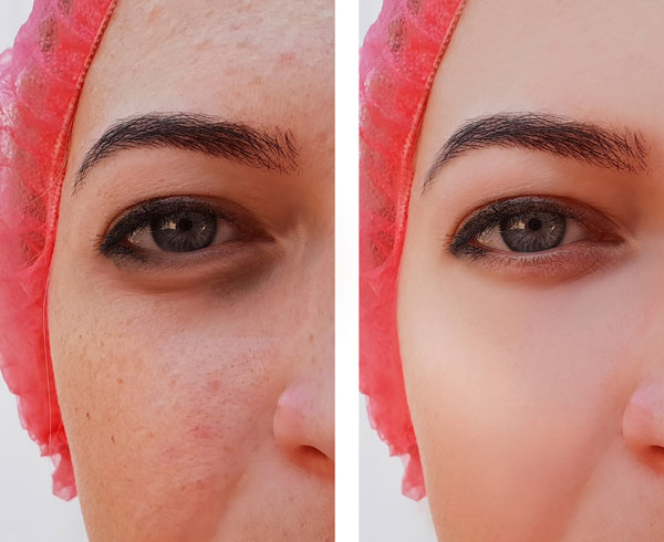 Facial Vessel Clearance & Pigment Reduction