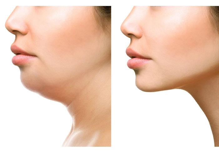 Kybella