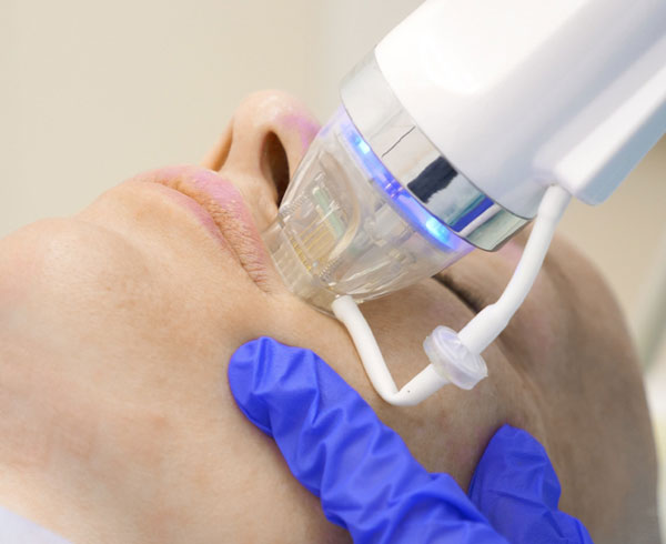 Radiofrequency Microneedling