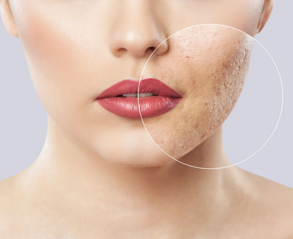 Skin Tightening / Skin Resurfacing