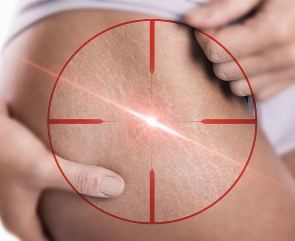 Stretch Marks Treatment