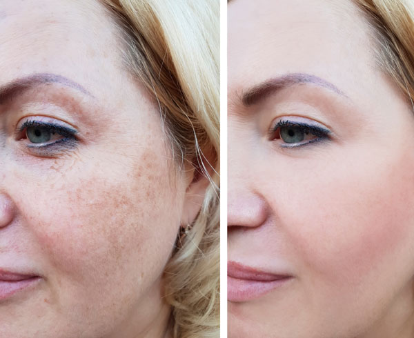 Surgical and Acne Scar Treatment