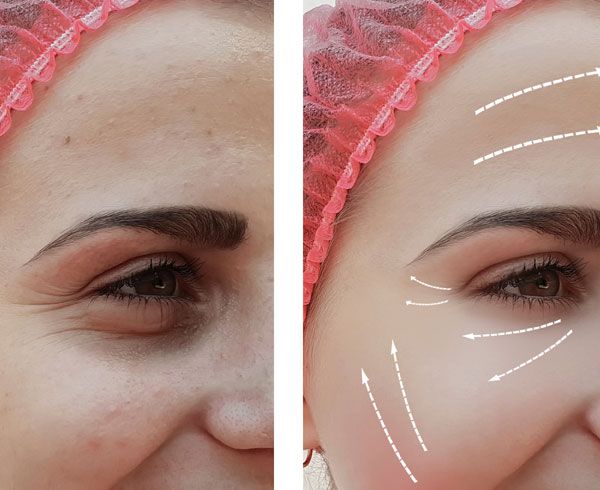 Wrinkle Reduction